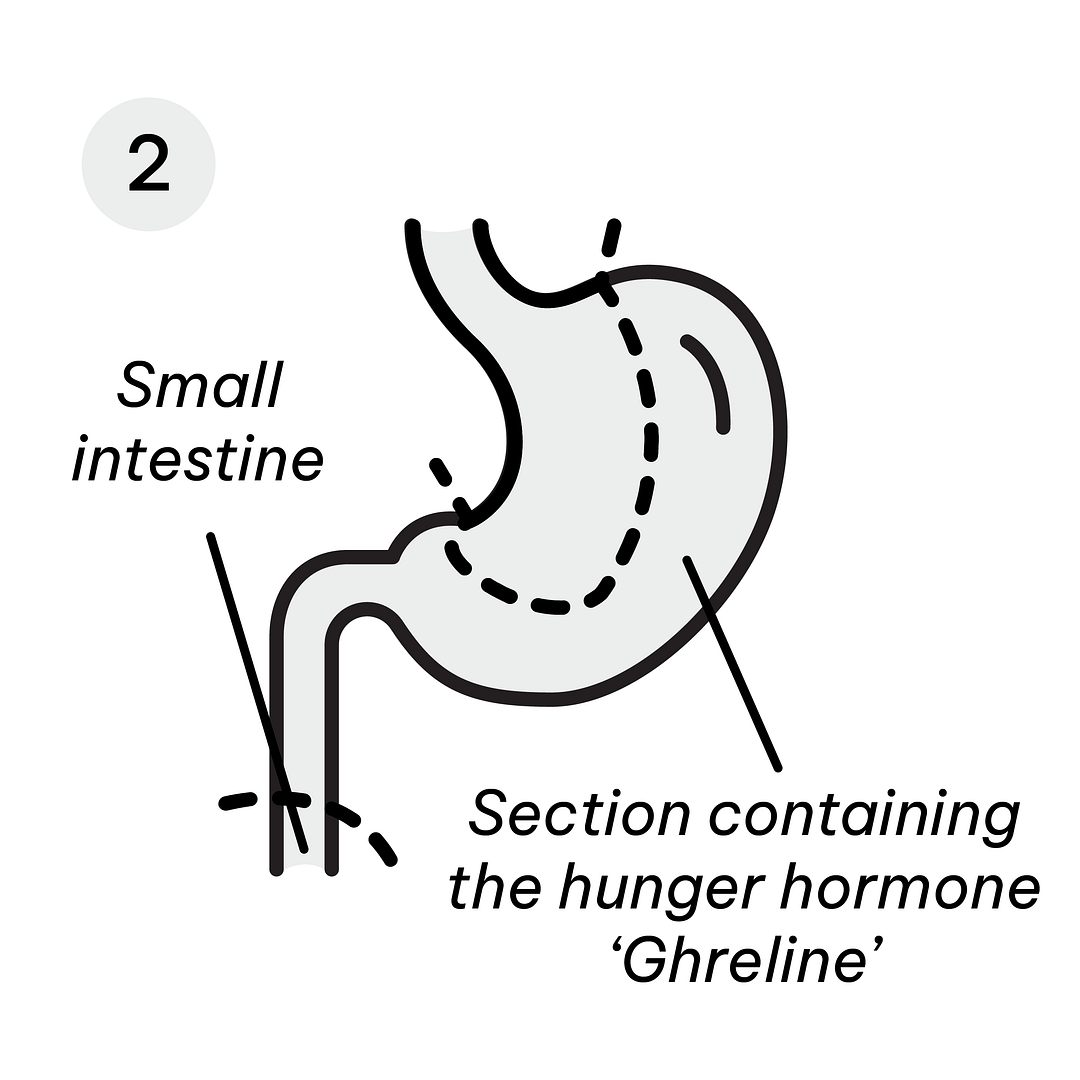 Gastric Diagrams_Mini GB 2