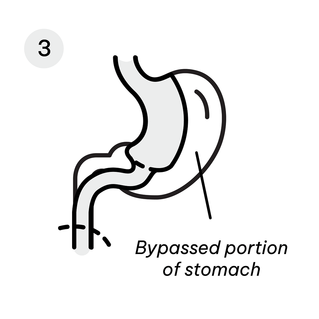 Gastric Diagrams_Mini GB 3