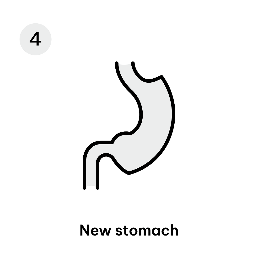 Gastric Sleeve Diagram-06