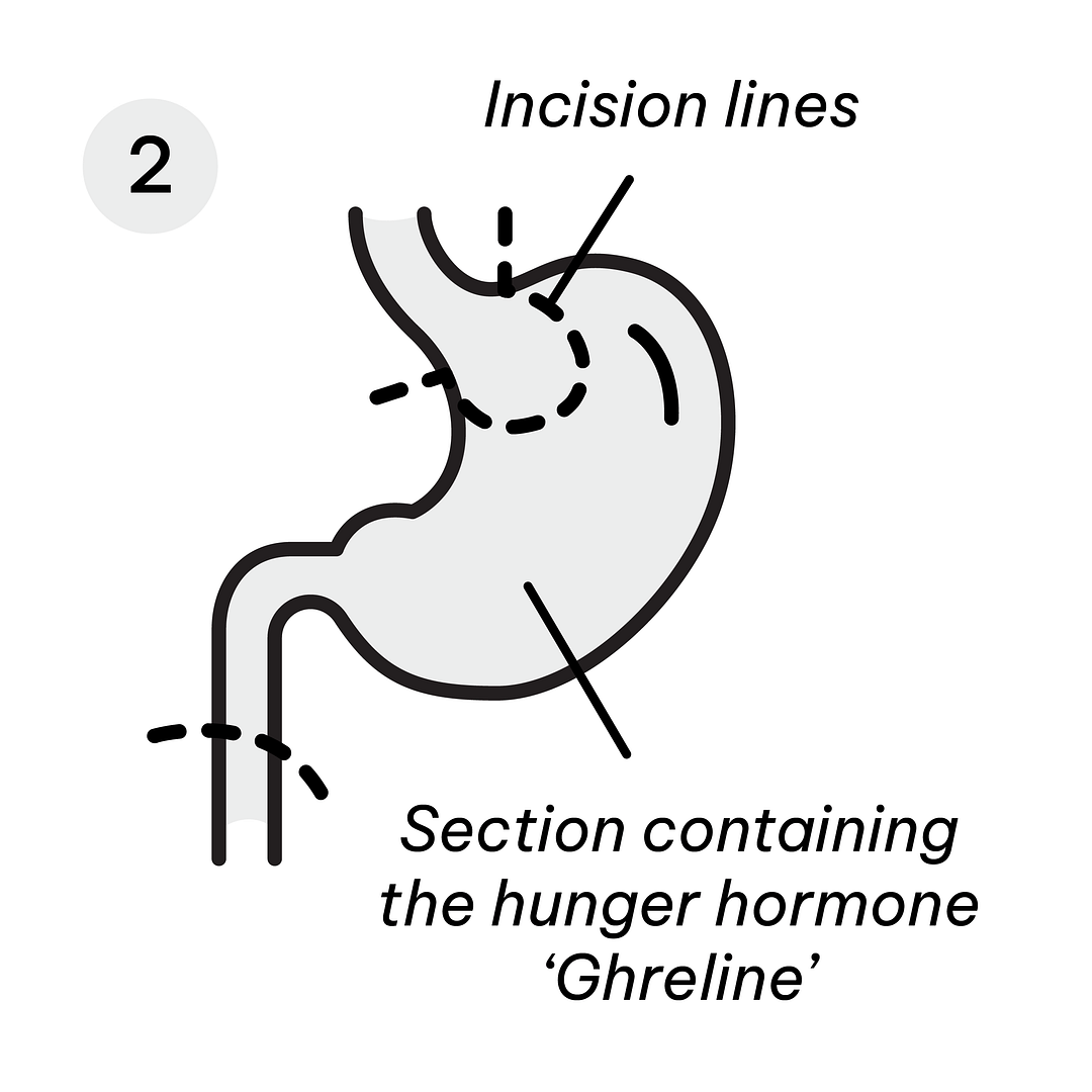 Gastric Sleeve Diagram-08