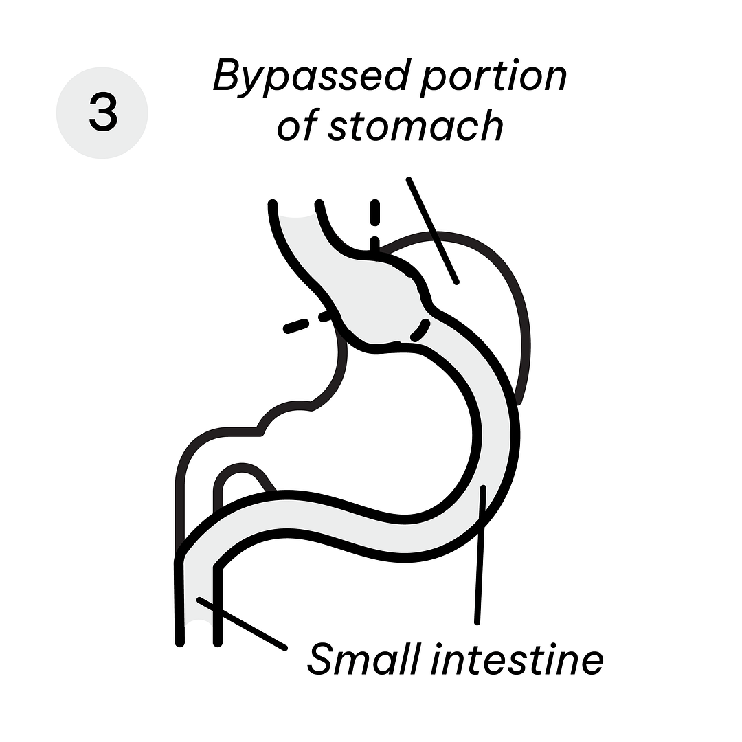 Gastric Sleeve Diagram-09