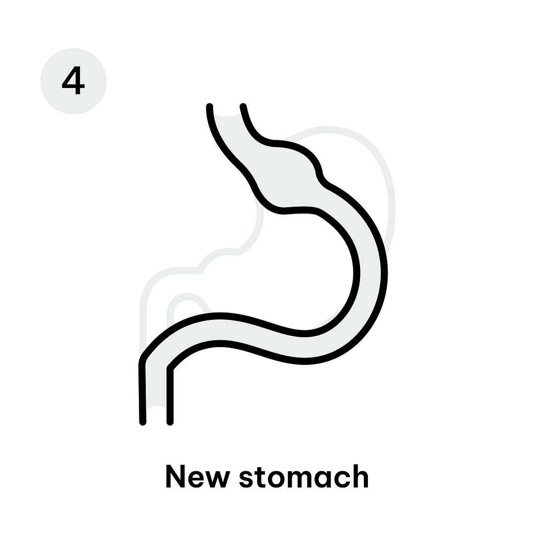 Gastric Sleeve Diagram-10