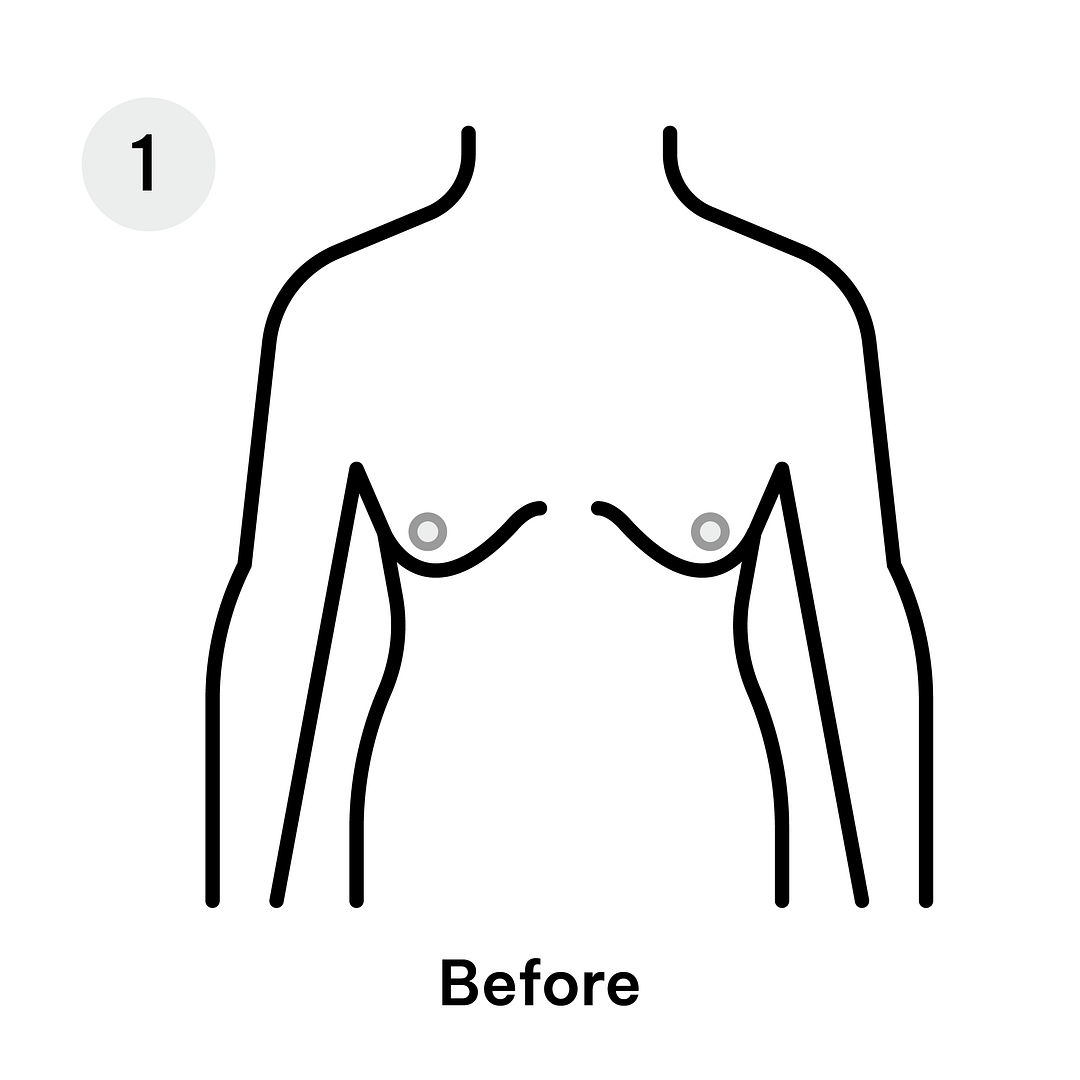 Gynaecomastia Pre Surgery