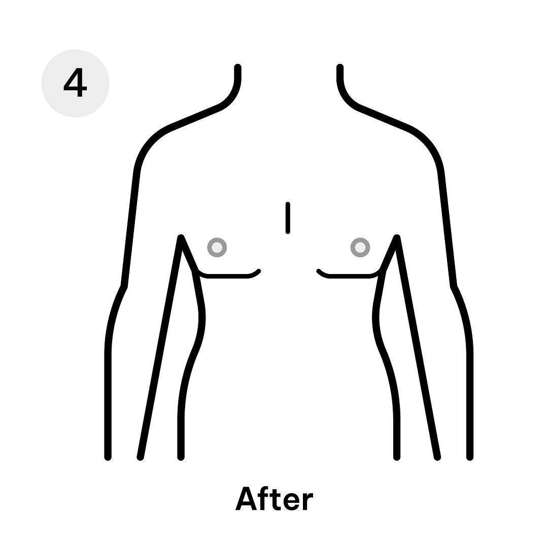 Gynaecomastia After