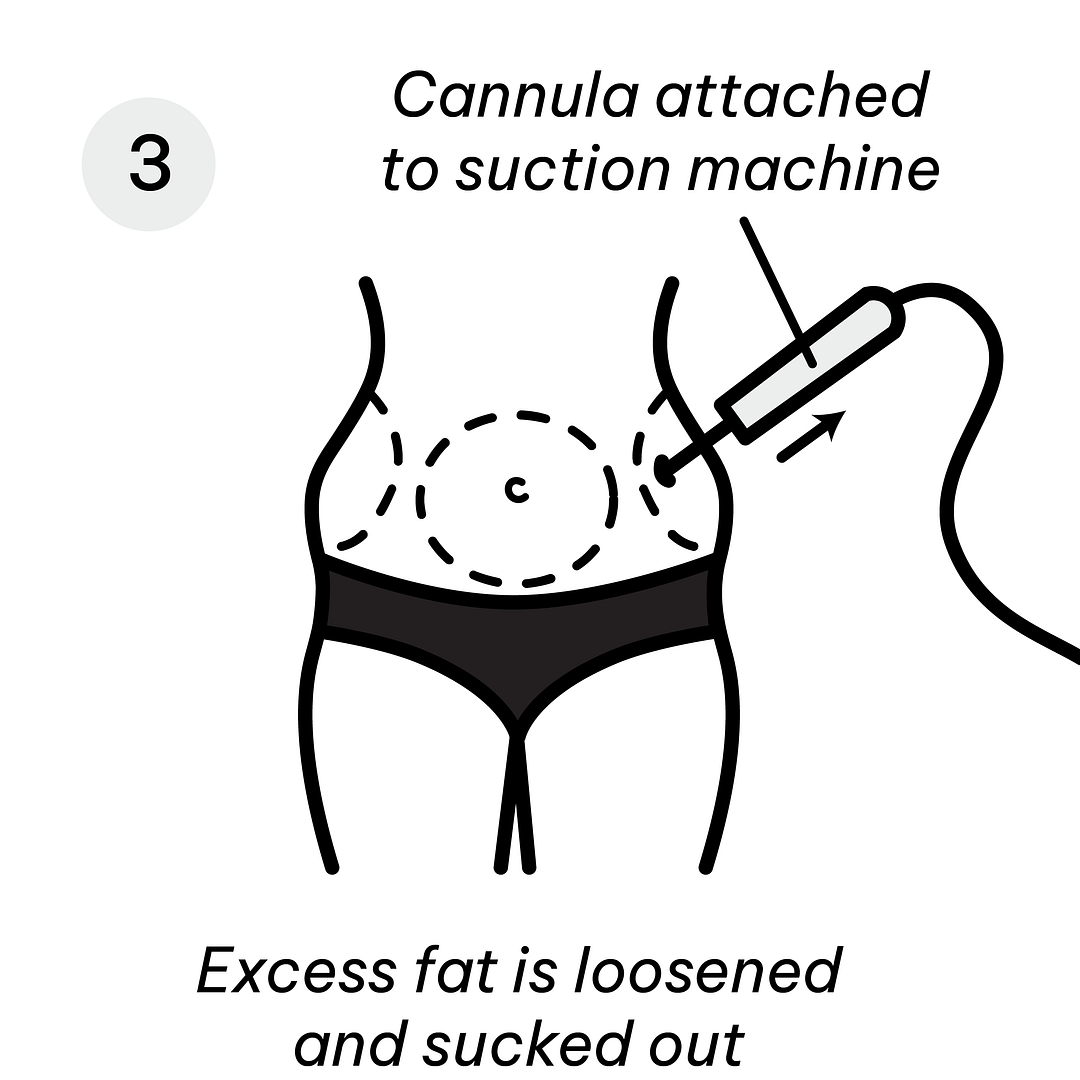 Liposuction Diagram