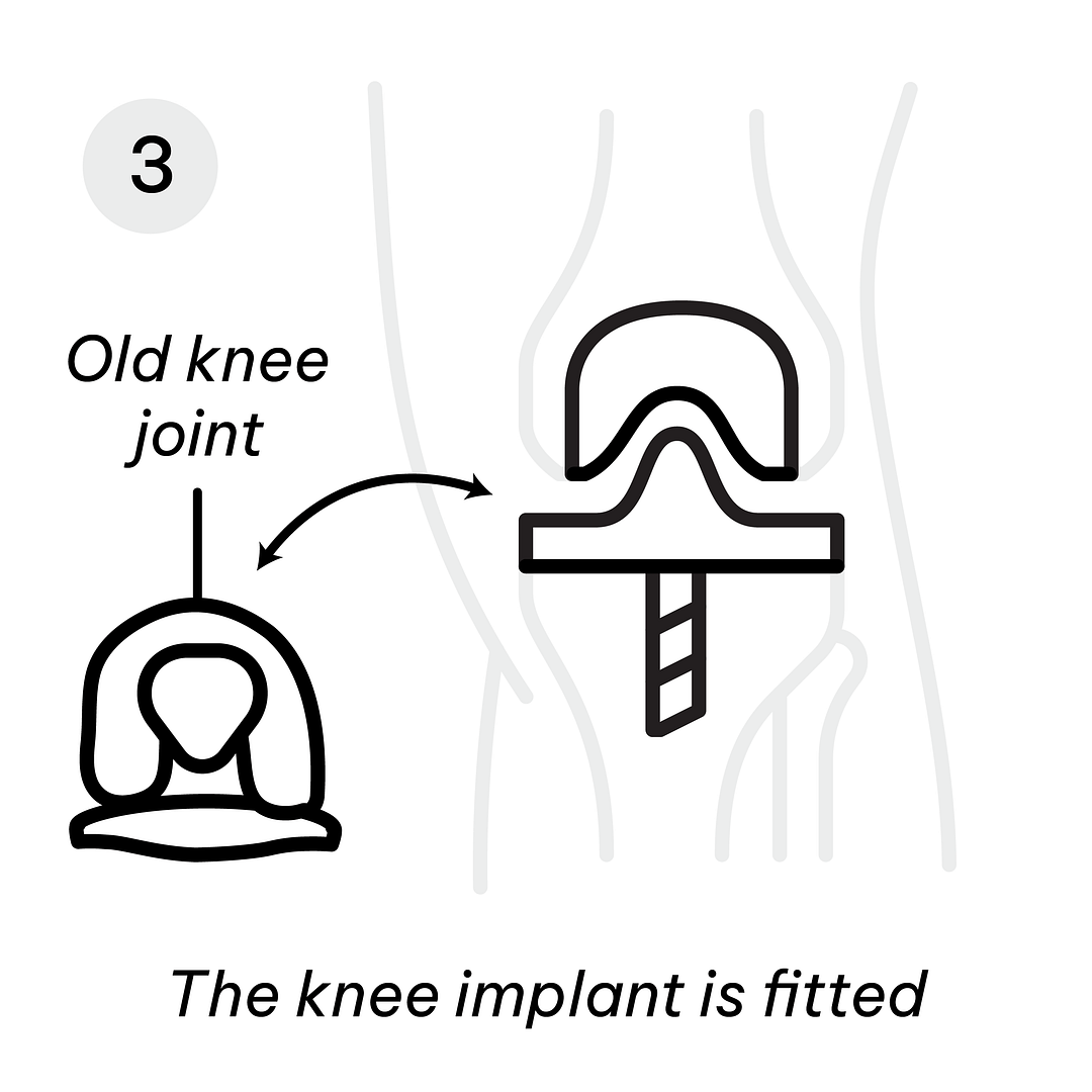 knee replacement