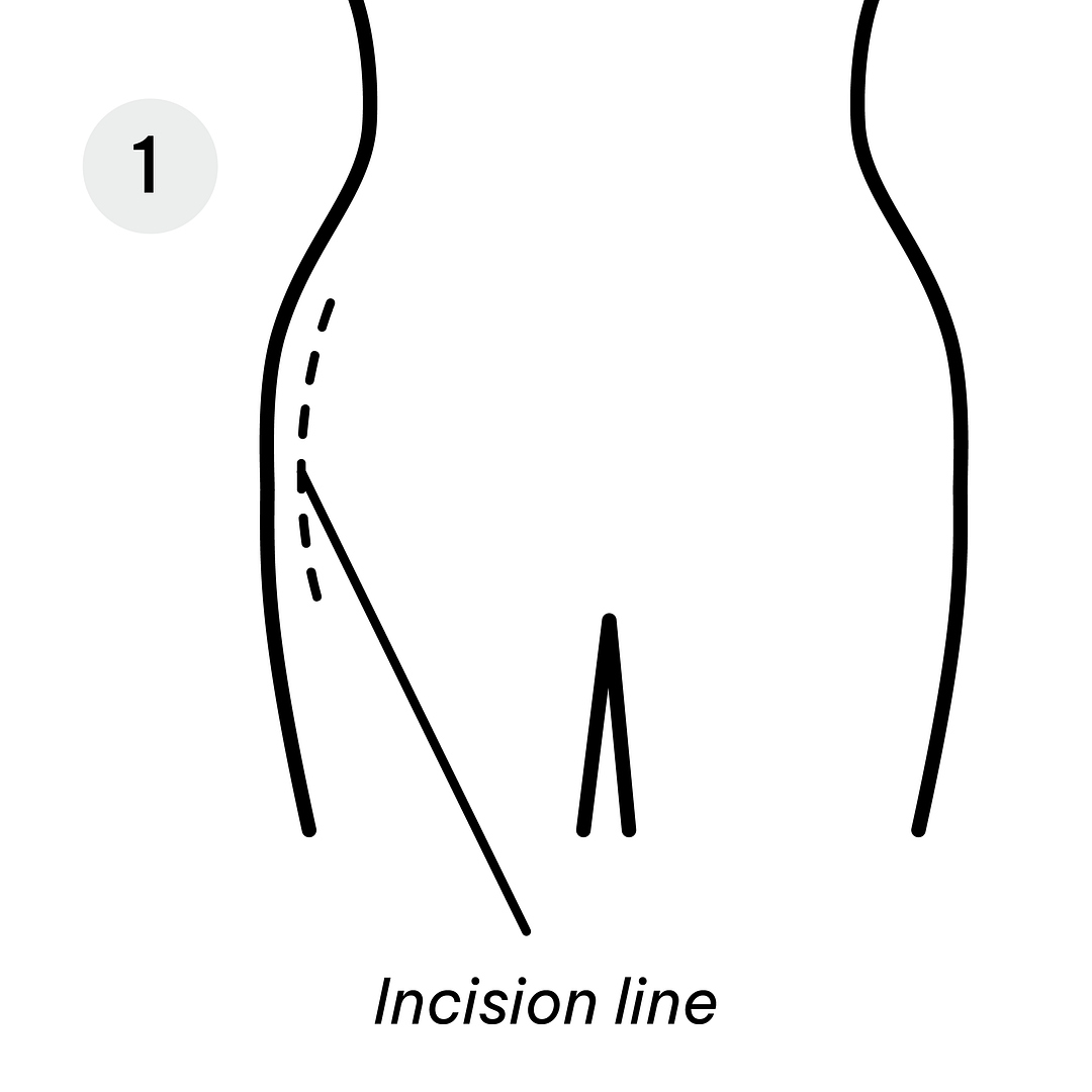 Gastric Diagrams_Hip Replacement 1