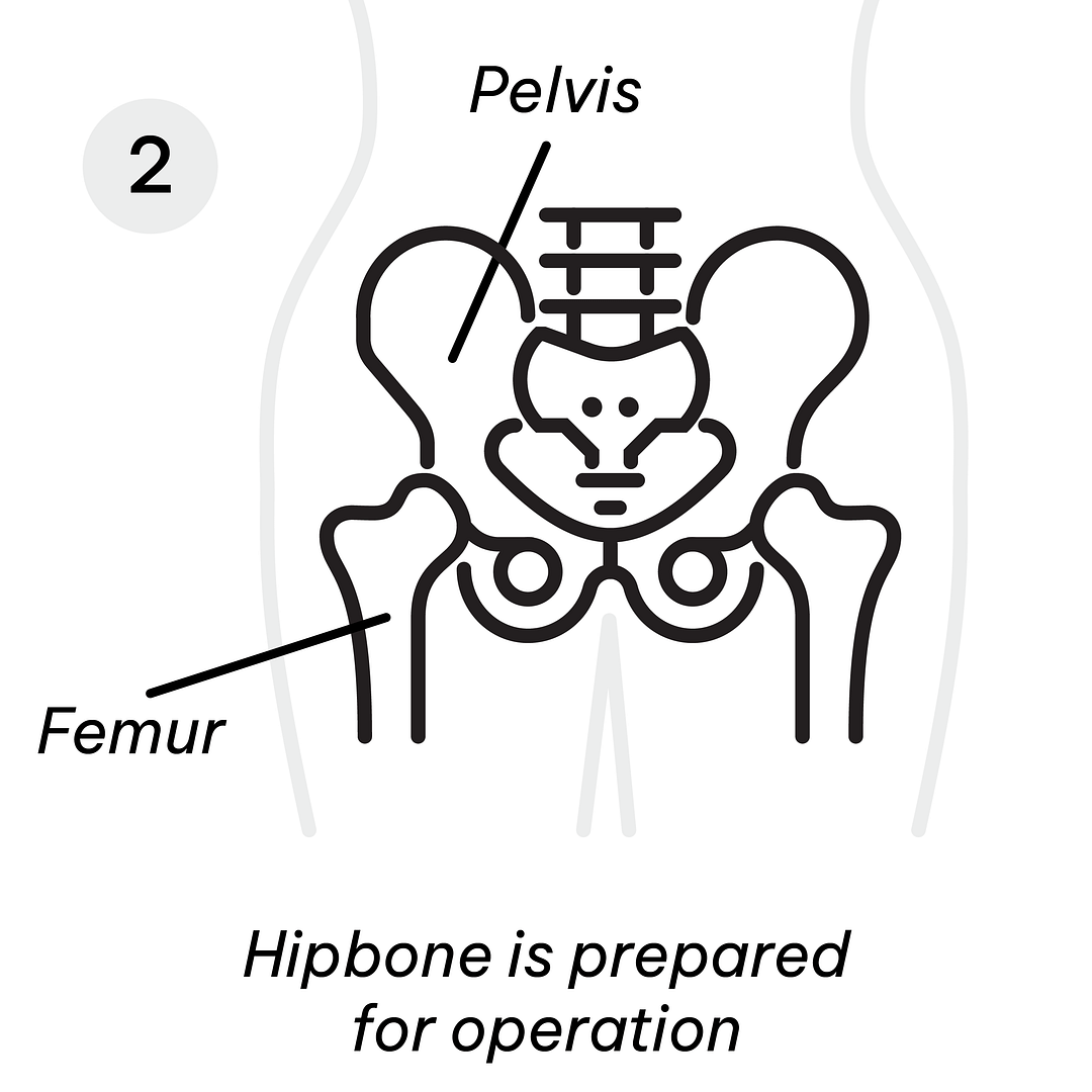 Gastric Diagrams_Hip Replacement 2