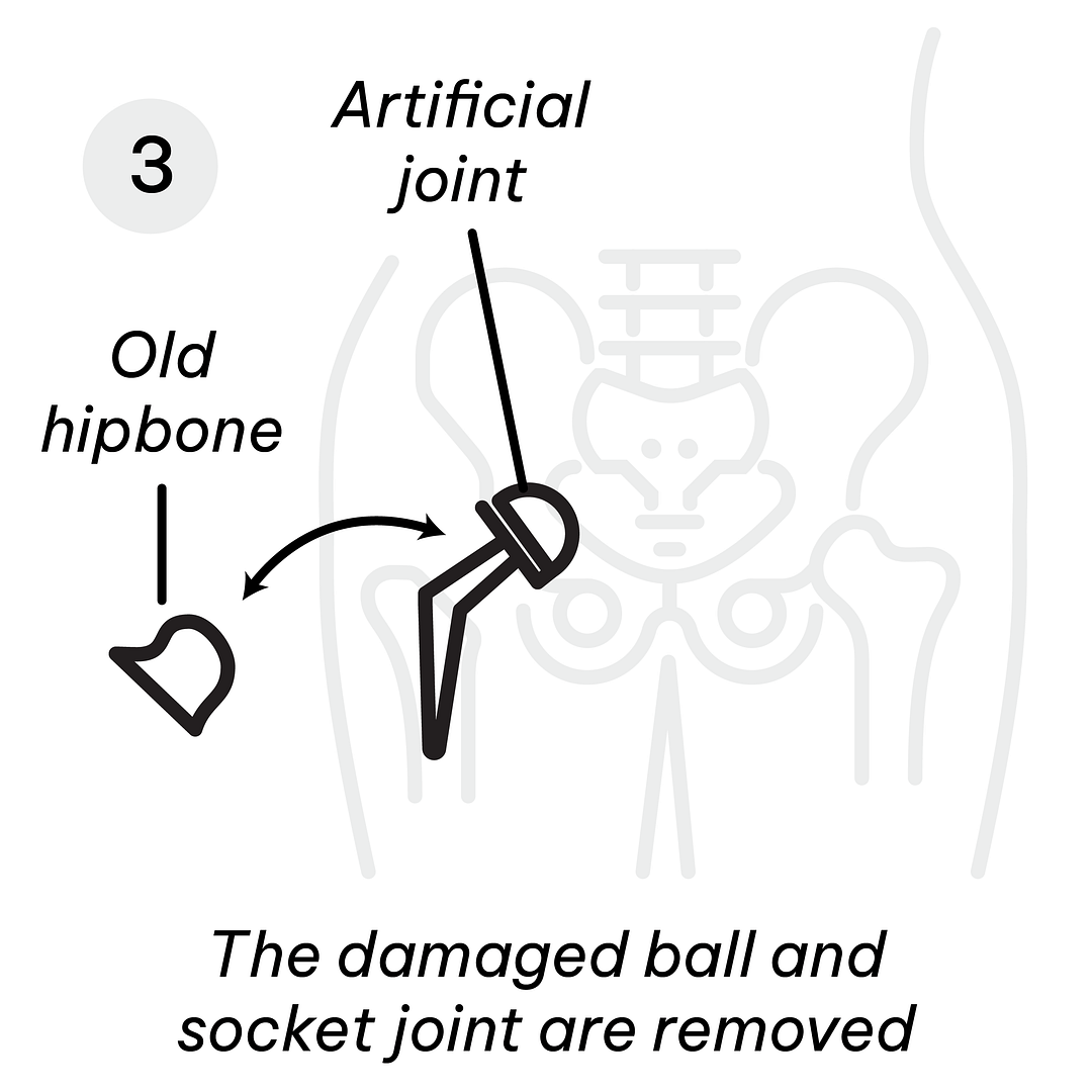 Gastric Diagrams_Hip Replacement 3