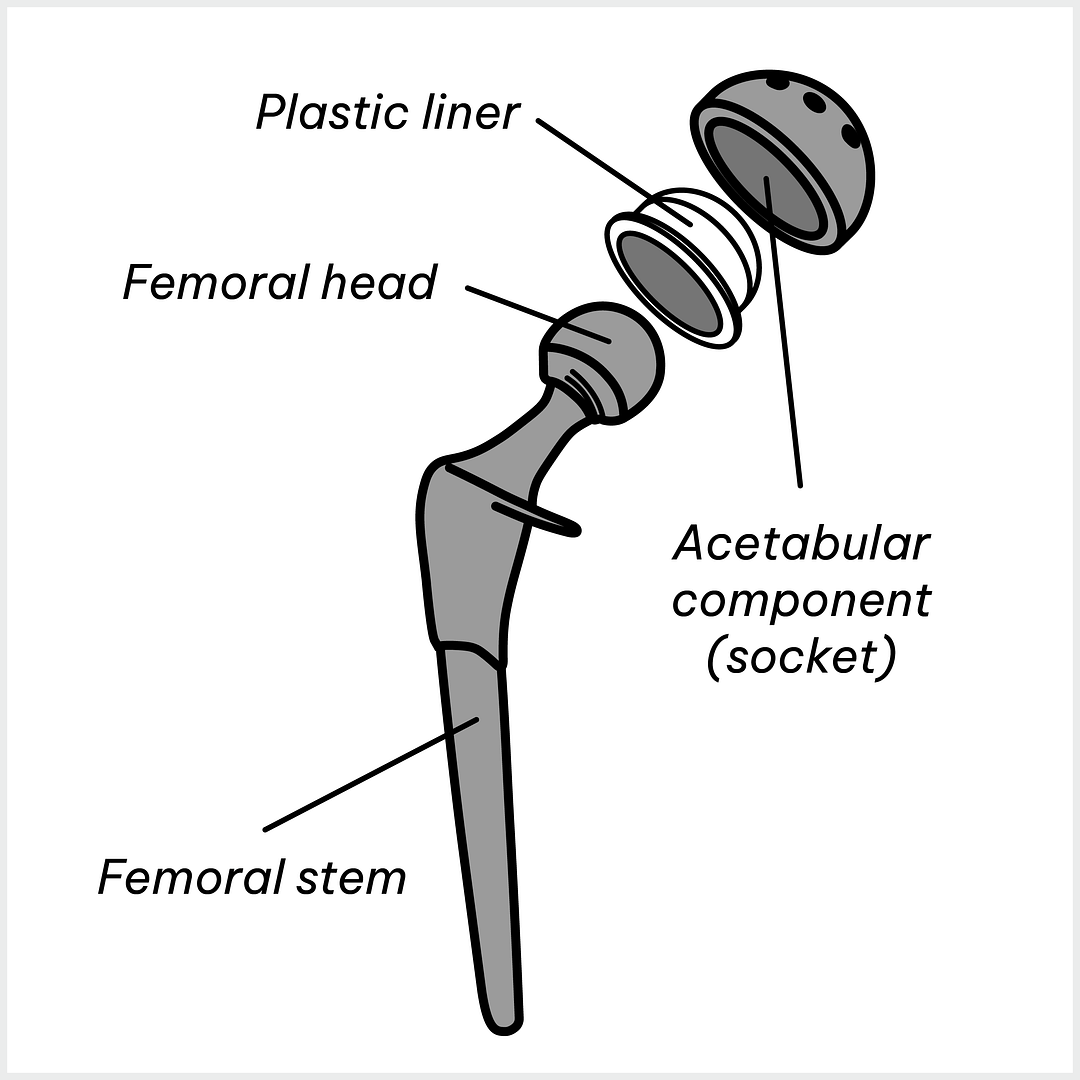 Hip implant 1