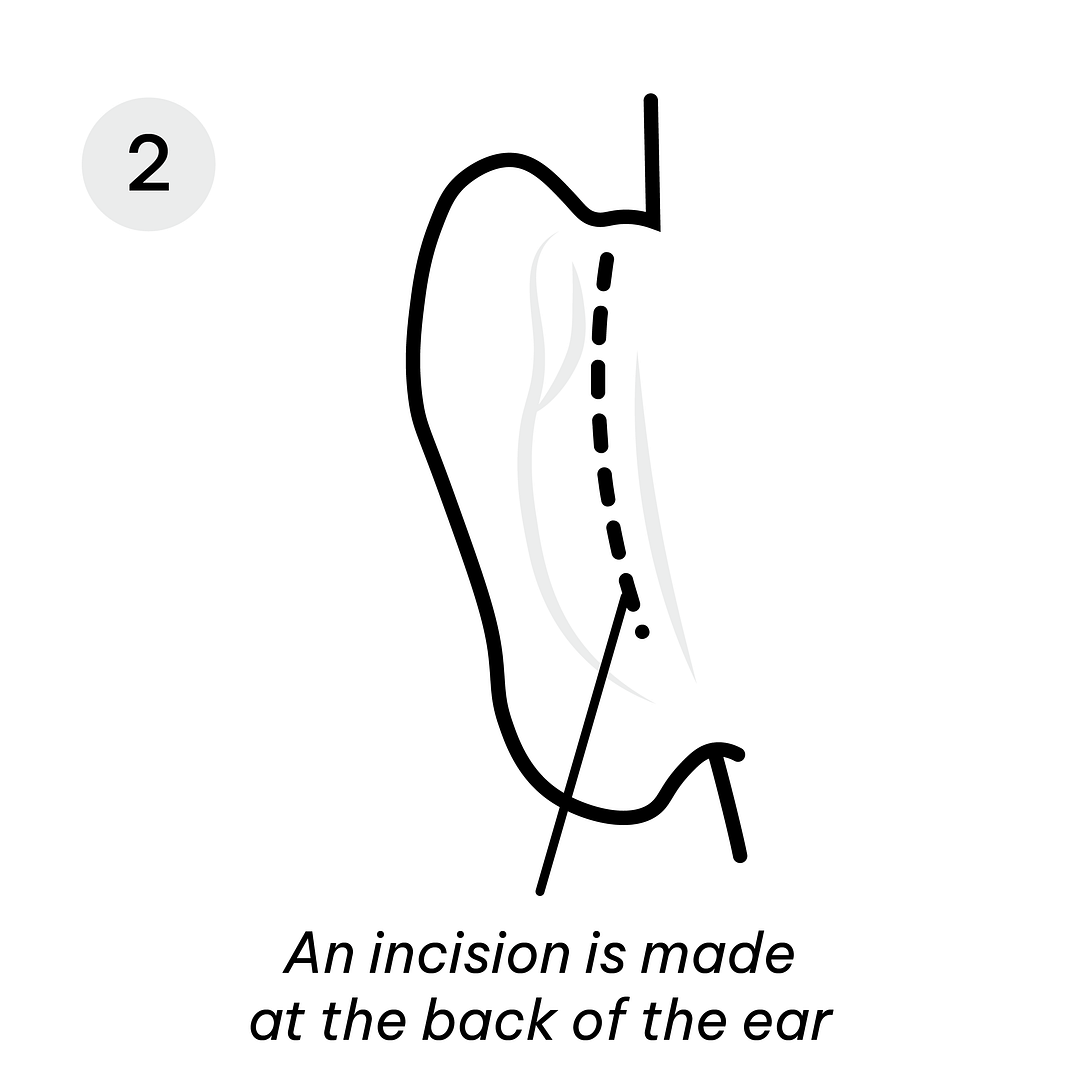 Otoplasty Incision 2