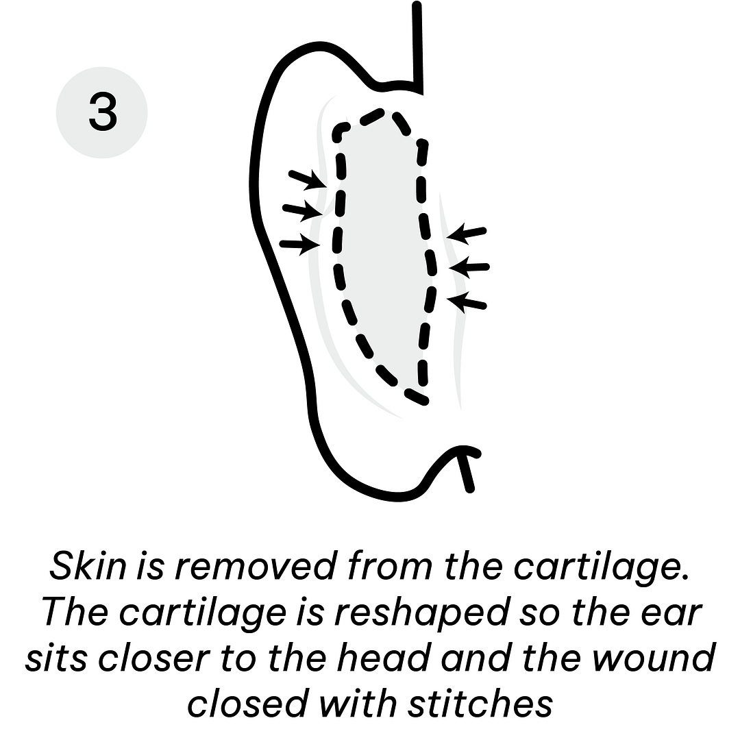 Otoplasty Surgery 3