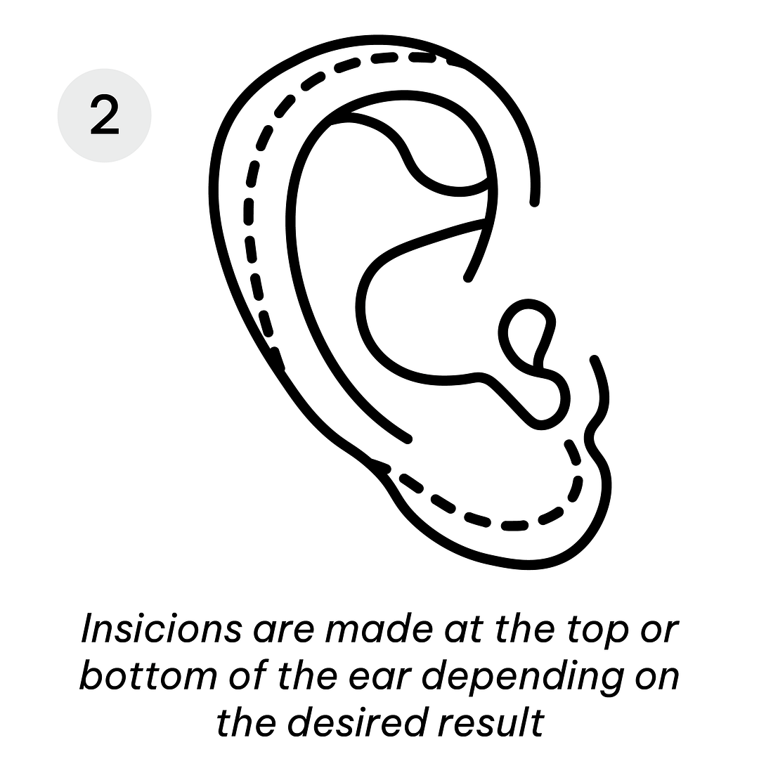Otoplasty Incision