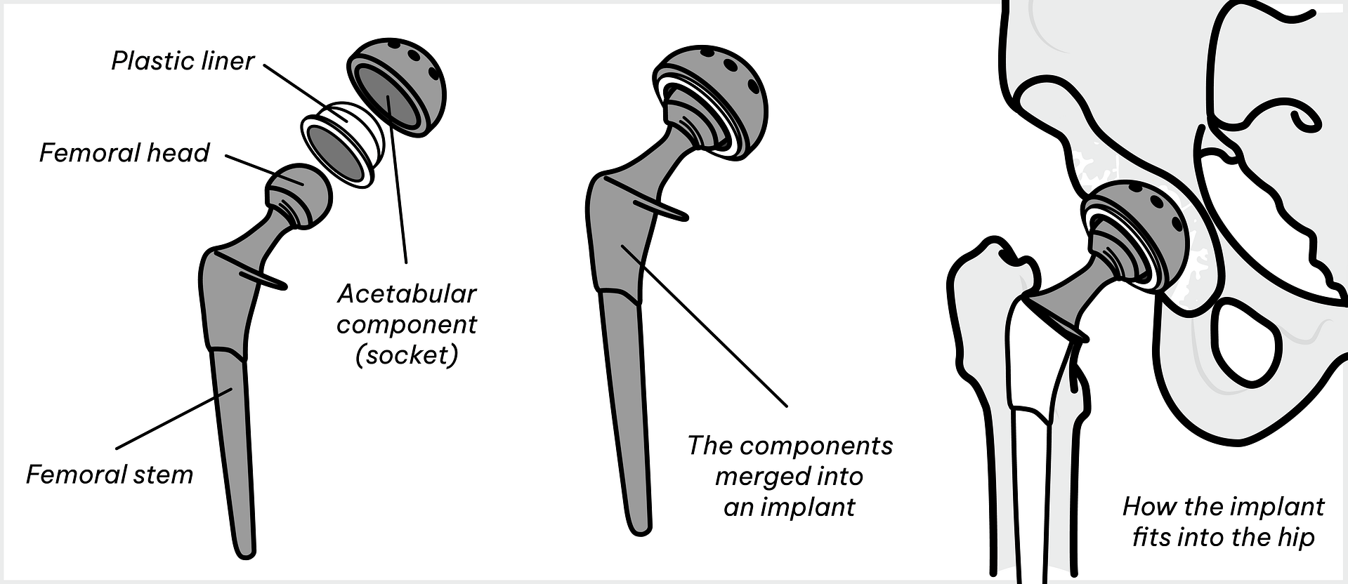 Hip Implant Surgery