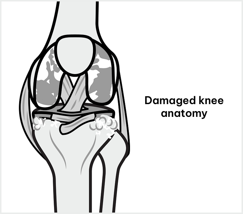 Damaged Knee