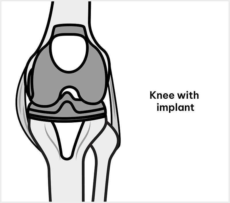 Knee with implant