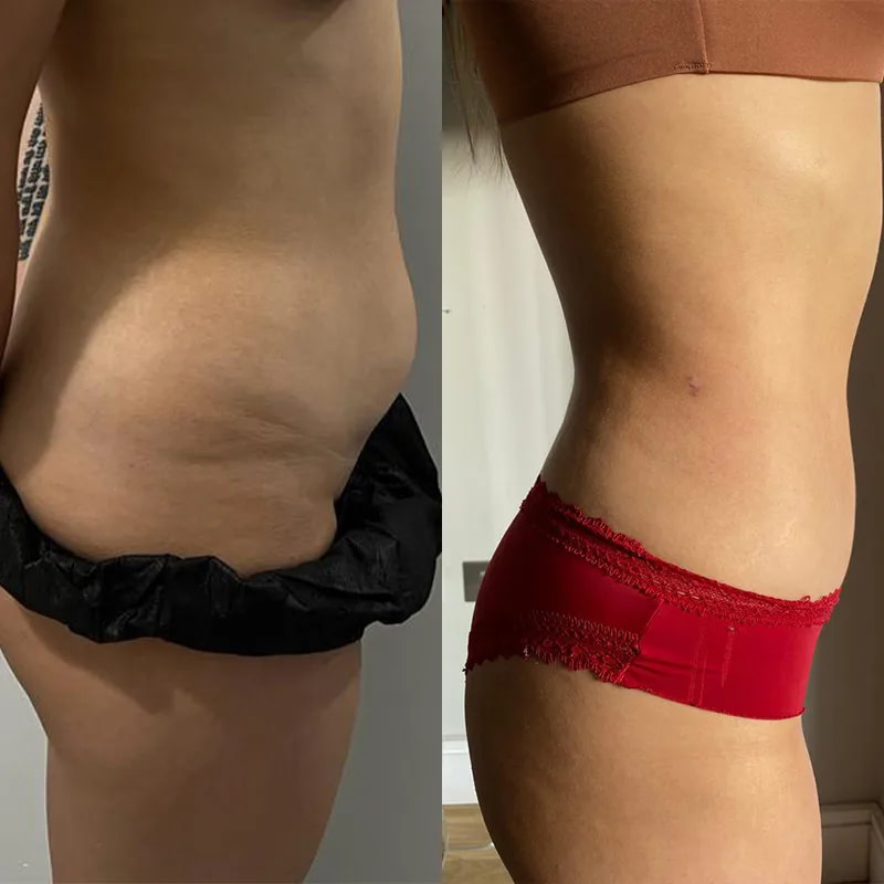 Vaser lipo before and after