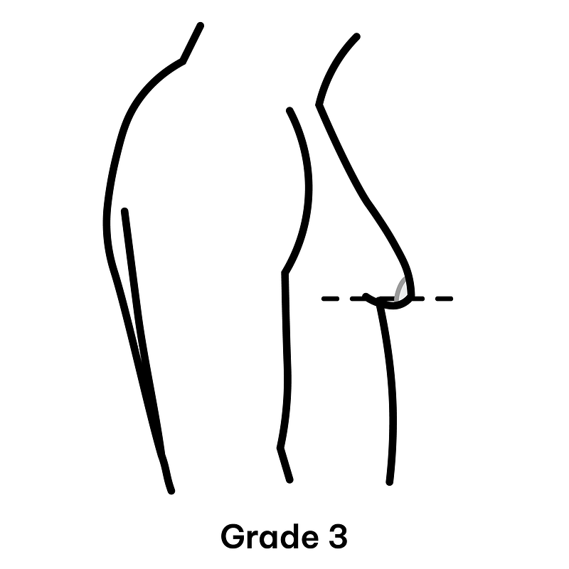 Gynaecomastia Grade 3